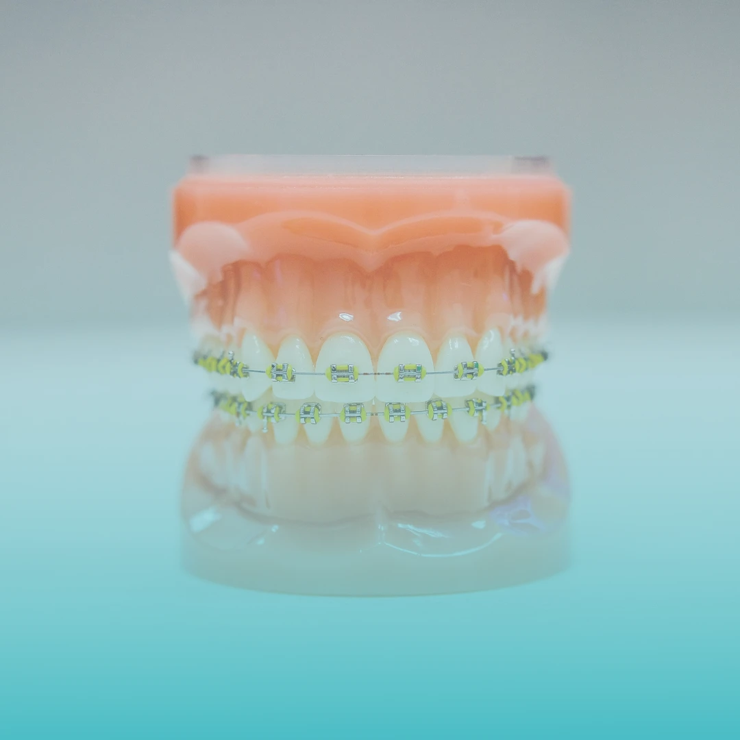 Orthodontie behandeling met beugel