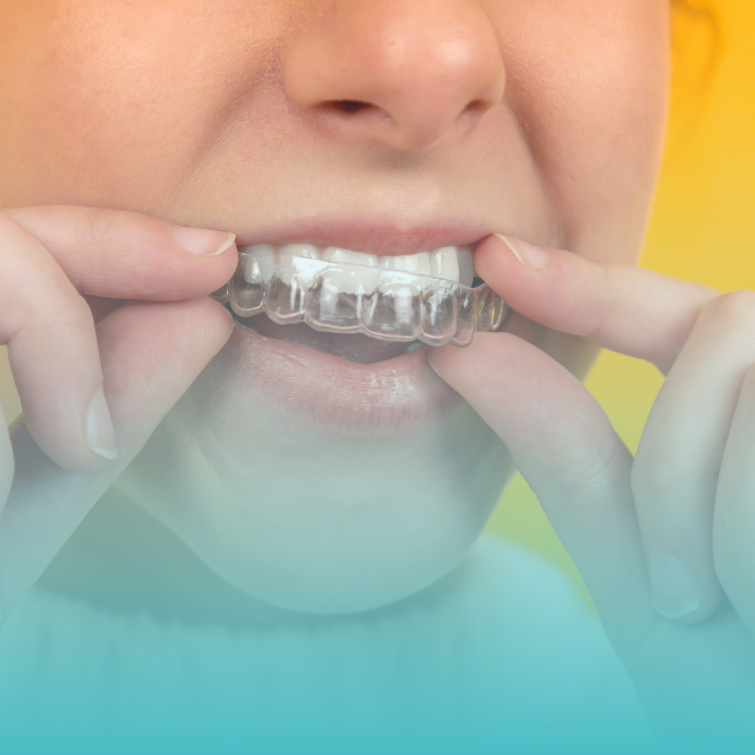 Invisalign beugel